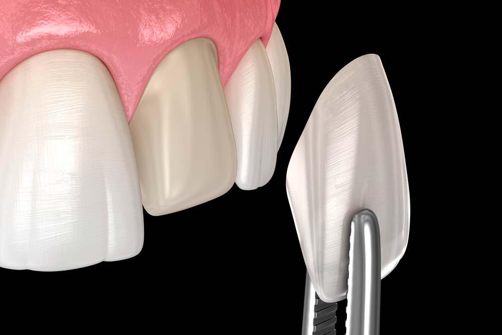 Hammaslaminaatti elegant