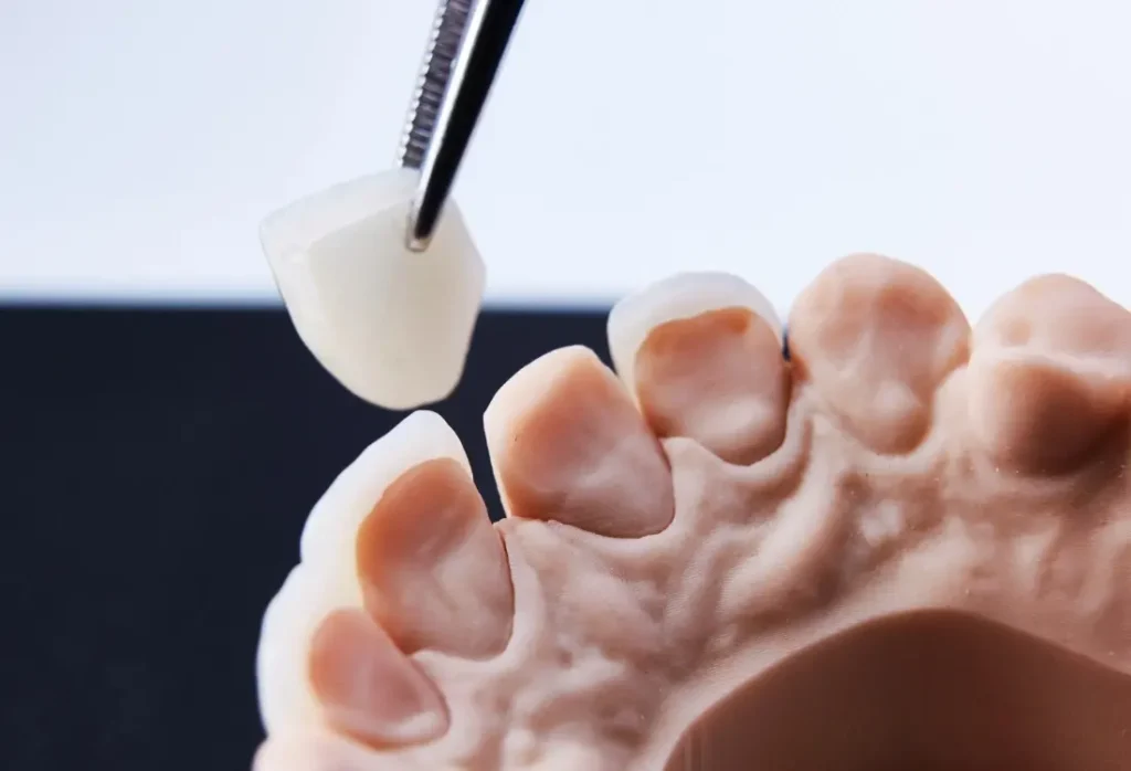 CEREC-kruunu ja keraaminen paikka – mitä CEREC-hoidosta kannattaa tietää?