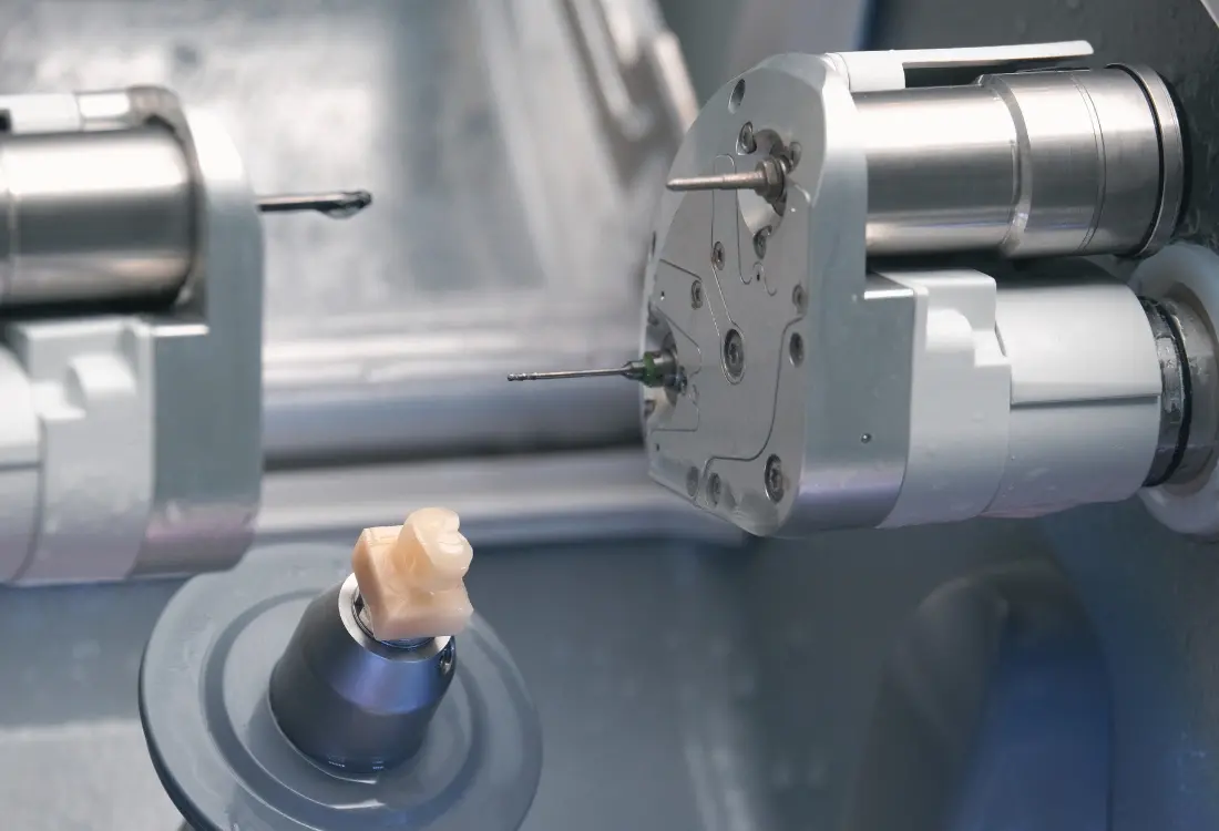 CEREC-tekniikalla valmistetaan keraamista kruunua jyrsinlaitteella, jonka kautta laajasti vaurioituneelle hampaalle saadaan kestävämpi ja erittäin luonnollinen lopputulos. 